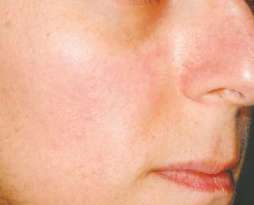 The same cheek after treatment