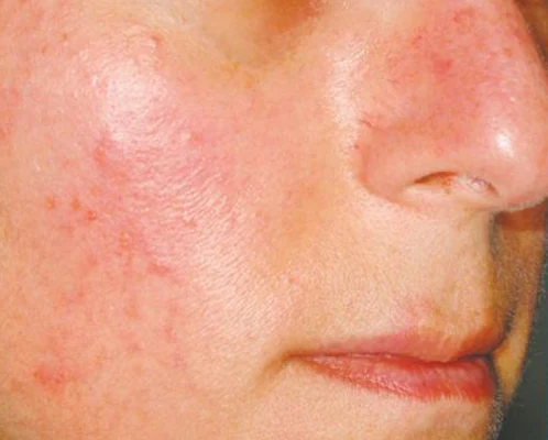 A participant's cheek before treatment